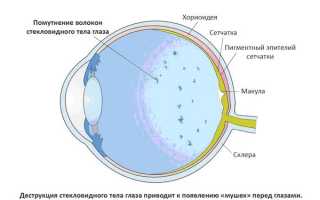 Деструкция стекловидного тела лечение и симптомы