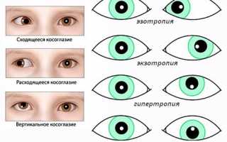 Особенности сходящегося косоглазия у взрослых и детей: верные диагностика и лечение