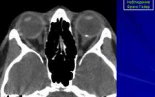 Друзы диска зрительного нерва – Optic disc drusen