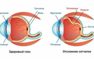 Регматогенная отслойка сетчатки: современные подходы к лечению