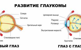 Частичная атрофия зрительного нерва